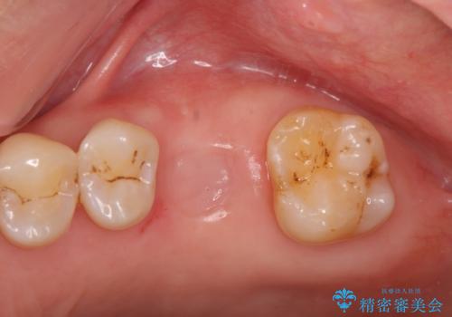 失った咬合機能の回復 インプラント治療の治療中