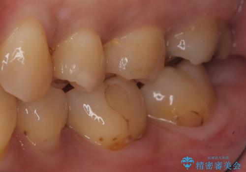 【セラミックインレー】銀の詰め物を白くしたいの治療前
