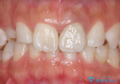 変色した前歯 ジルコニアクラウンでの修復の症例 治療後