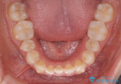 インビザライン矯正 短期間でがたつきのないきれいな歯並びにの治療中