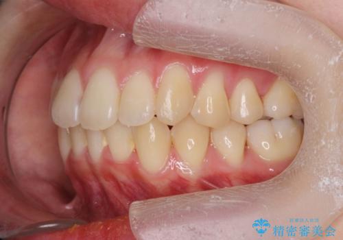 前歯のがたつきをマウスピース矯正できれいに!の治療後