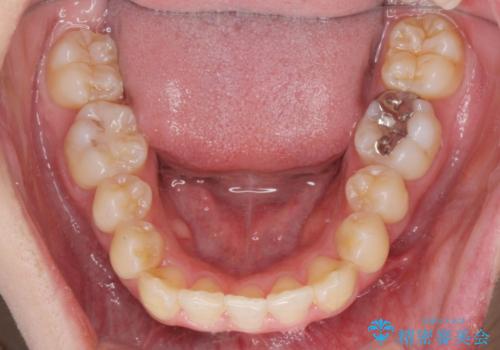 前歯のがたつきをマウスピース矯正できれいに!の治療後