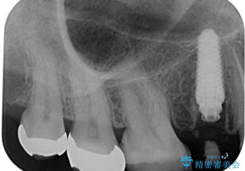 歯が折れている(1DAY インプラント)の治療中