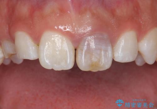 変色した前歯 ジルコニアクラウンでの修復の治療前
