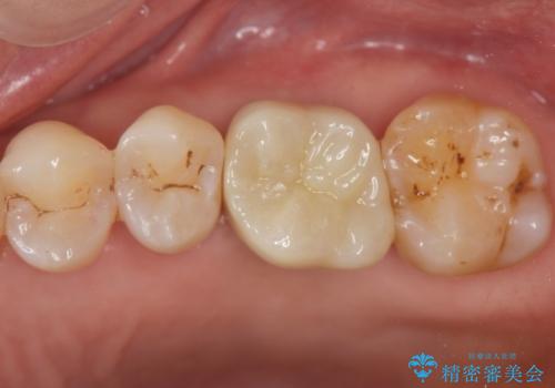 失った咬合機能の回復 インプラント治療の治療後