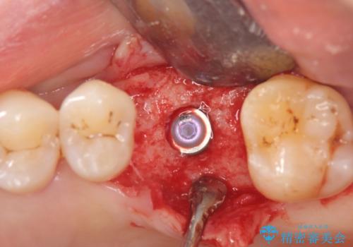 失った咬合機能の回復 インプラント治療の治療中