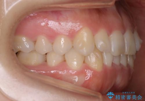 インビザライン矯正 短期間でがたつきのないきれいな歯並びにの治療中