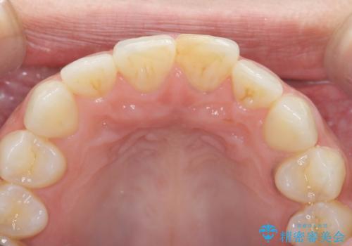 すり減った前歯の形態回復の治療前