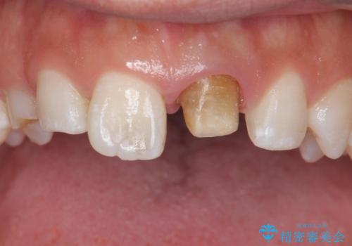 変色した前歯 ジルコニアクラウンでの修復の治療中