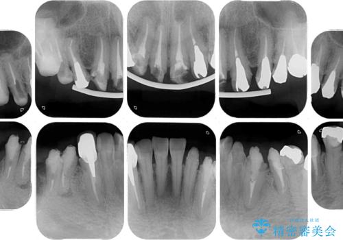 治療を開始したもののうまく噛めない 咬合改善のオールセラミック補綴治療の治療前