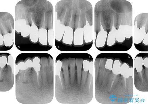 治療を開始したもののうまく噛めない 咬合改善のオールセラミック補綴治療の治療後