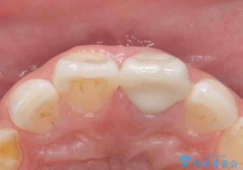 変色した前歯 ジルコニアクラウンでの修復の治療後