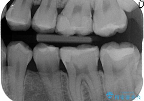 保険治療のプラスチックが劣化し虫歯に。　セラミックでつぎはぎなく治療の治療前
