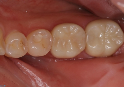保険治療のプラスチックが劣化し虫歯に。 セラミックでつぎはぎなく治療の治療後