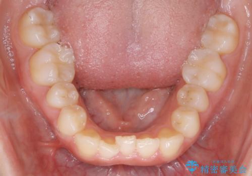 インビザライン矯正 短期間でがたつきのないきれいな歯並びにの治療前
