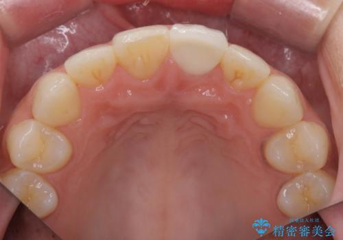 すり減った前歯の形態回復の治療後