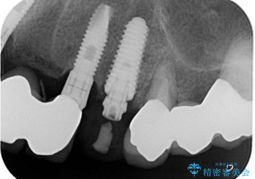 【抜歯即時埋入即時過重】1DAYインプラントの治療中
