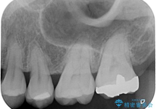 【セラミックインレー】銀の詰め物を白くしたいの治療前