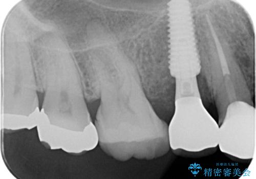 歯が折れている(1DAY インプラント)の治療後
