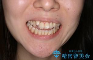 本来は外科ケース:インビザラインで前歯の重度がたつきとオープンバイトの改善の治療前(顔貌)