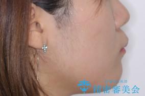 出っ歯と深い噛み合わせ:抜歯矯正で口元スッキリ!の治療前(顔貌)