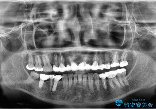 歯が折れている(1DAY インプラント)の治療前