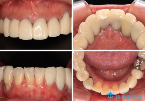 治療を開始したもののうまく噛めない 咬合改善のオールセラミック補綴治療の治療前
