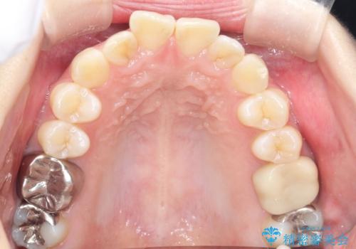 前歯のガタつきをマウスピース矯正で改善の治療前