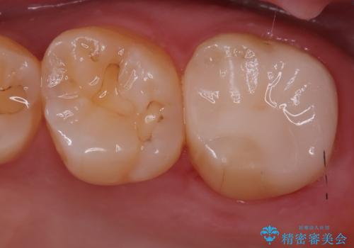 【セラミックインレー】銀の詰め物を白くしたいの症例 治療後