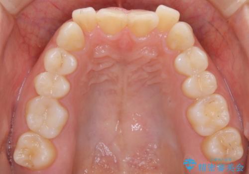 インビザライン矯正　短期間でがたつきのないきれいな歯並びにの治療前