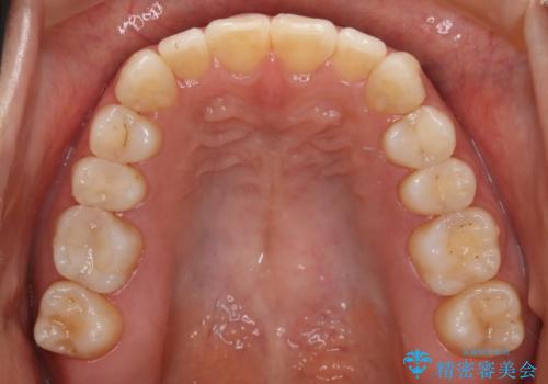 インビザライン矯正 短期間でがたつきのないきれいな歯並びにの治療後