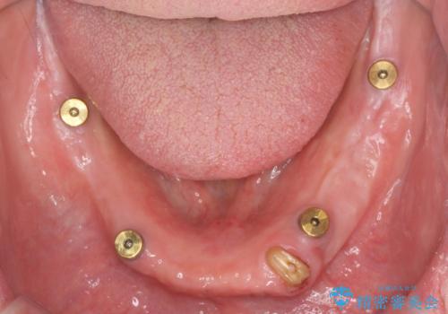 しっかり咬める入れ歯 インプラントオーバーデンチャーの症例 治療前