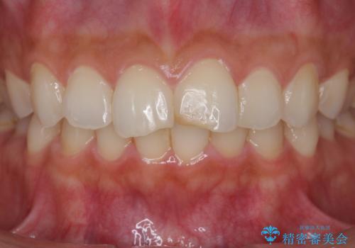 すり減った前歯の形態回復の治療前