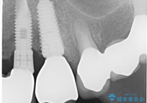 【抜歯即時埋入即時過重】1DAYインプラントの治療後