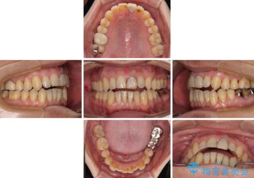 外科手術を検討? 過大な開咬をワイヤー装置とインビザラインで劇的に改善するの治療中