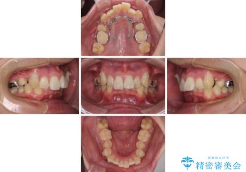 八重歯の抜歯矯正 インビザラインを用いて気になる歯並びを改善の治療中