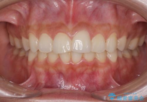 すり減った前歯の形態回復の治療後