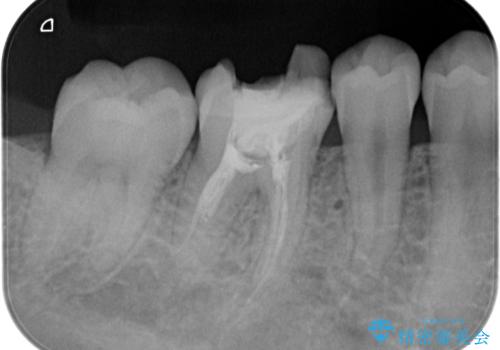 【根管治療】ラバーダムと顕微鏡を用いた治療の治療前