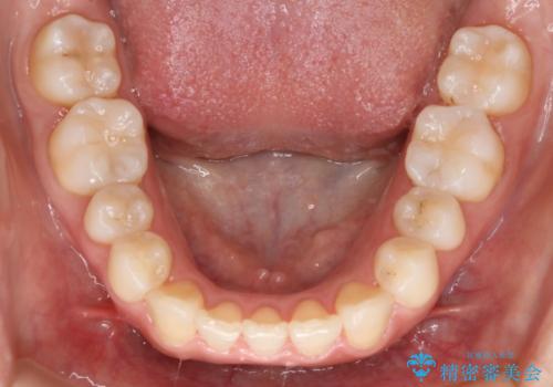 インビザライン矯正　短期間でがたつきのないきれいな歯並びにの治療後