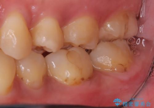 【セラミックインレー】銀の詰め物を白くしたいの治療後