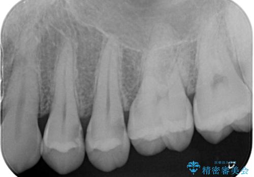 虫歯をランクの高い材料で治したい　セラミックインレーの症例 治療前