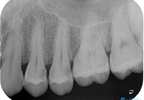 虫歯をランクの高い材料で治したい　セラミックインレーの症例 治療前