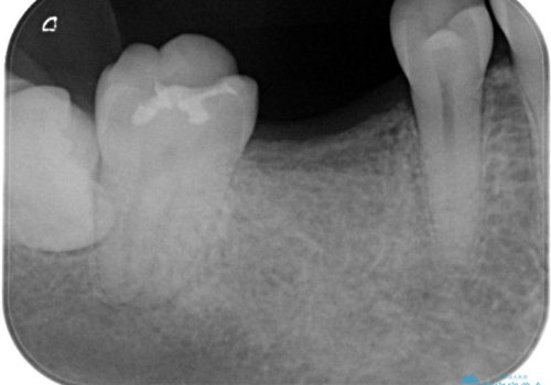 失ったままの臼歯　インプラントによる治療の症例 治療前