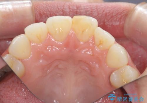 すり減った前歯の形態回復の治療前