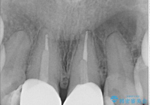 【オールセラミッククラウン】前歯の色が気になる!の治療後