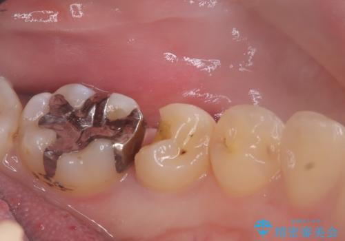 【セラミックインレー】詰め物が外れたので、ついでに白くしたいの治療前