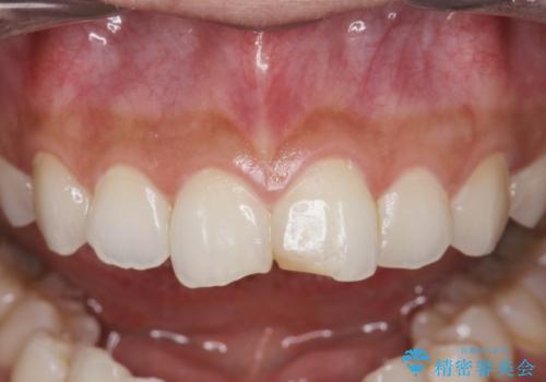 すり減った前歯の形態回復の治療前