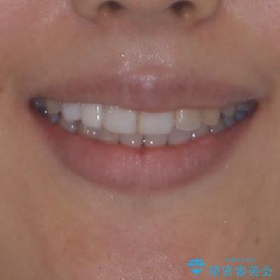 前歯のデコボコが気になる インビザラインによる矯正治療の治療後(顔貌)