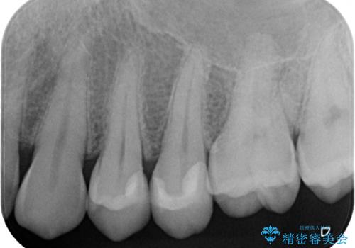 虫歯をランクの高い材料で治したい　セラミックインレーの治療後