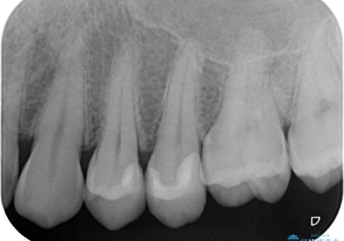 虫歯をランクの高い材料で治したい セラミックインレーの治療後